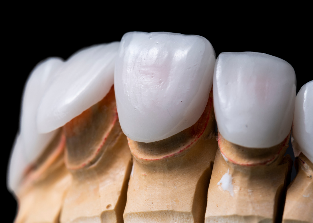 Dental Veneers