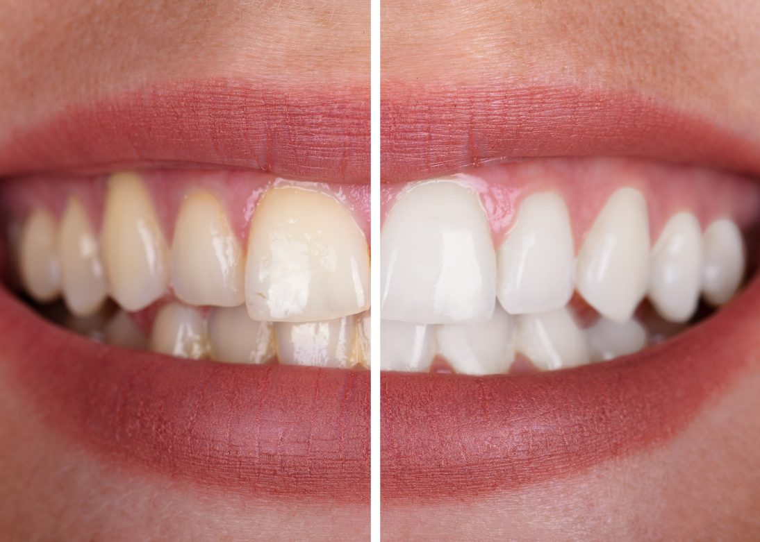 Tooth Whitening